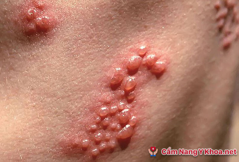 Chẩn đoán Bệnh viêm da dạng herpes của Duhring-Brocq