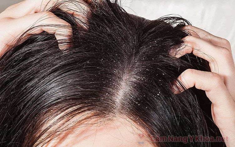 Nấm tóc - Nguyên nhân, chẩn đoán và cách điều trị