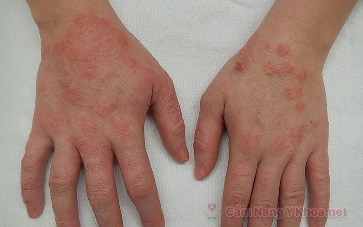 Viêm da tiếp xúc do côn trùng - Nguyên nhân, chẩn đoán và cách điều trị